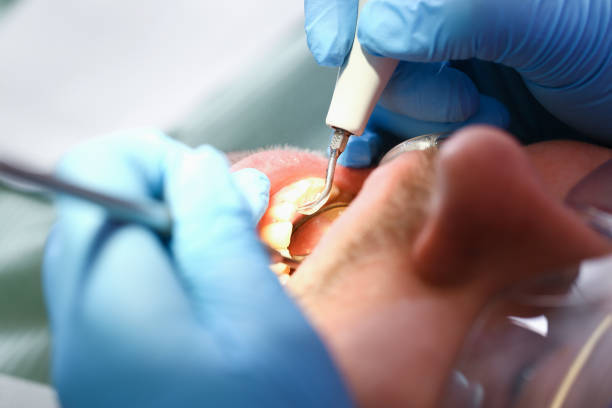 Best Knocked-Out Tooth (Avulsed Tooth) Treatment in Gilbertsville, PA